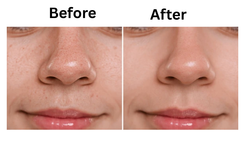 Before and after results using Kaya Acne Free Purifying Cleanser for oily and acne-prone skin
