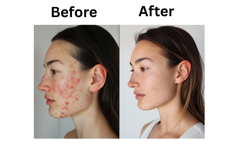 Before and after using Neutrogena Oil-Free Acne Wash Pink Grapefruit – visible reduction in blackheads and clearer, smoother skin