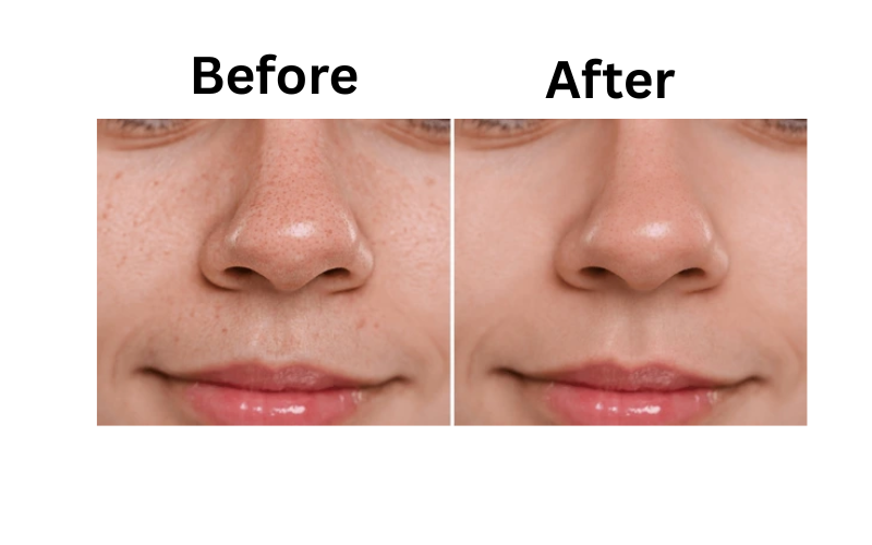 Before and after results using Mamaearth Tea Tree Face Wash