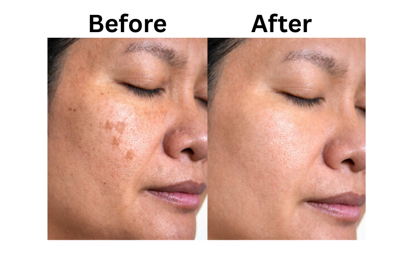 Before and after using Himalaya Purifying Neem Face Wash – reduced oil, fewer pimples, and naturally glowing skin