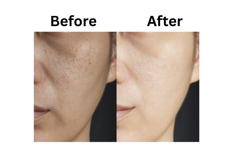 Before and after results using Dot & Key Cica Calming Blemish Clearing Face Wash for clear and calm skin