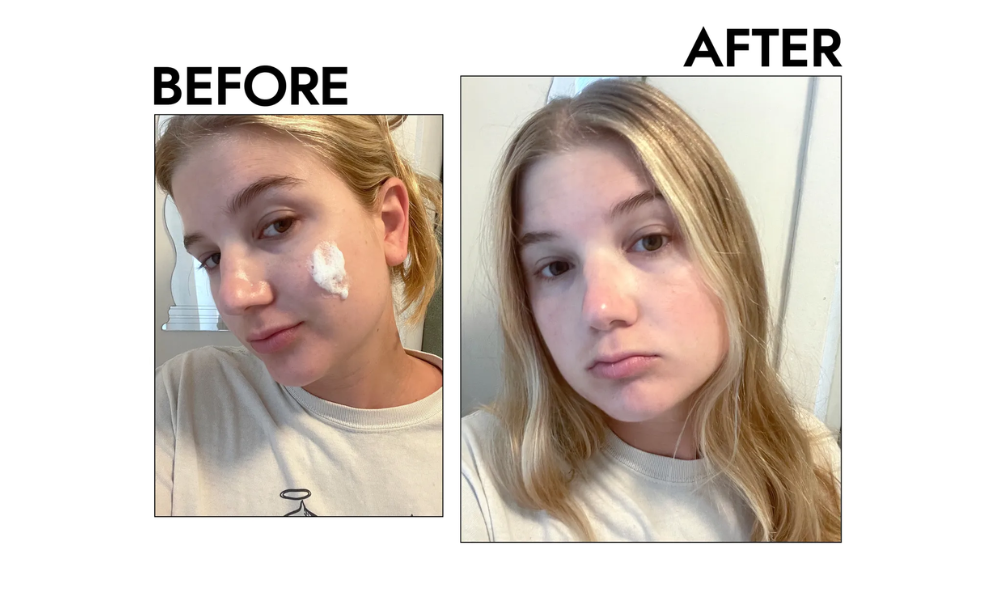 Before and after results of La Roche-Posay Effaclar Foaming Gel for oily skin