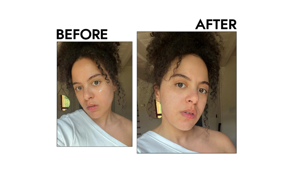 Before and after results of Neutrogena Oil-Free Acne Wash showing reduced acne, blackheads, and improved skin texture